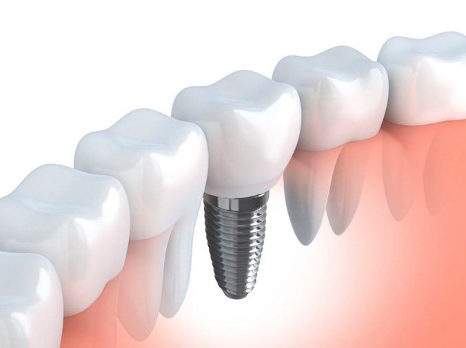 Cuidados antes y después de colocar un implante dental